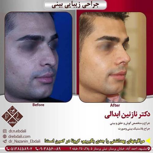 جراحی-بینی-مشهد-255