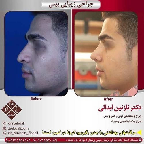 جراحی-بینی-مشهد-256