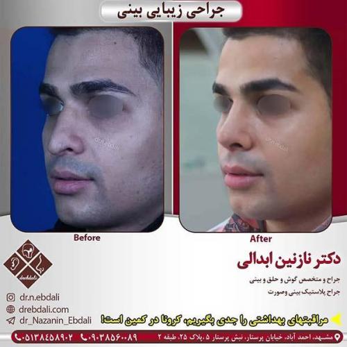 جراحی-بینی-مشهد-257