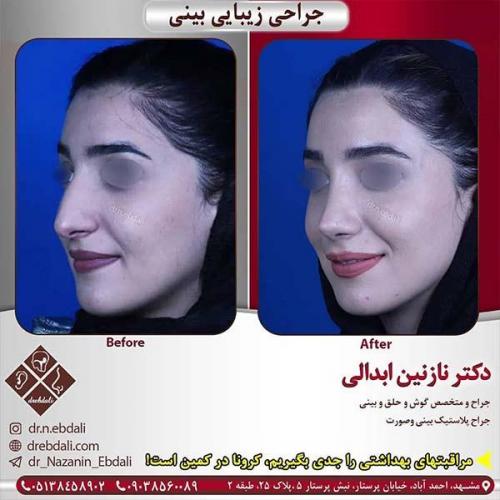 جراحی-بینی-مشهد-259
