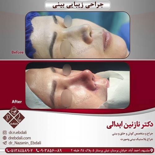 جراحی-بینی-مشهد-26
