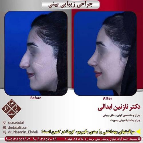 جراحی-بینی-مشهد-260