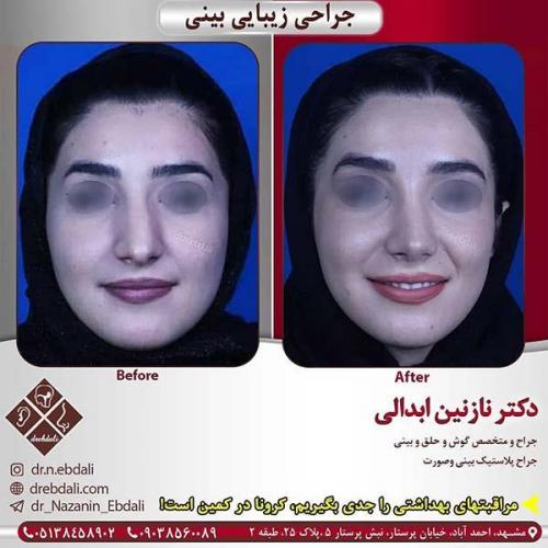 جراحی-بینی-مشهد-261