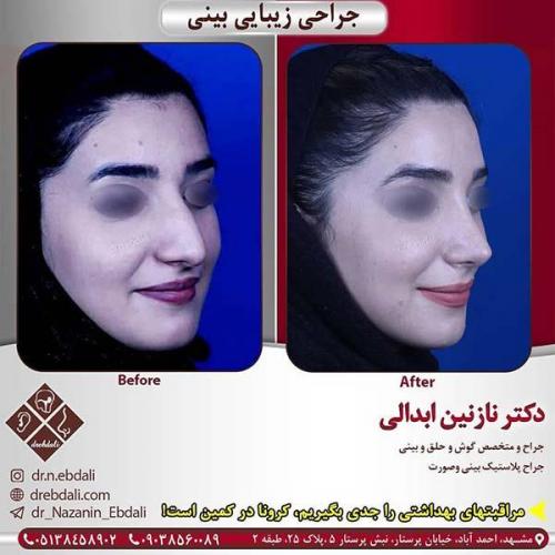 جراحی-بینی-مشهد-262