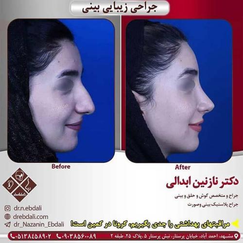 جراحی-بینی-مشهد-263