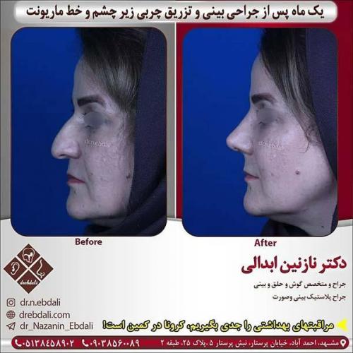 جراحی-بینی-مشهد-266