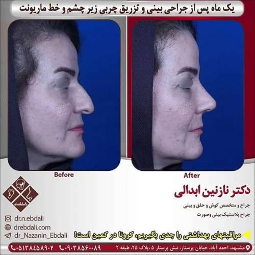 جراحی-بینی-مشهد-267