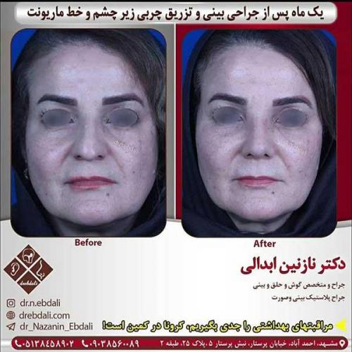 جراحی-بینی-مشهد-268