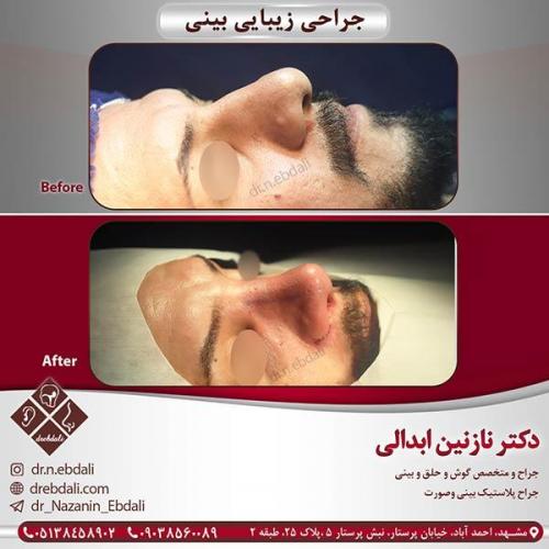 جراحی-بینی-مشهد-30