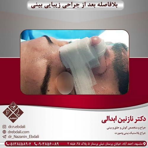 جراحی-بینی-مشهد-32