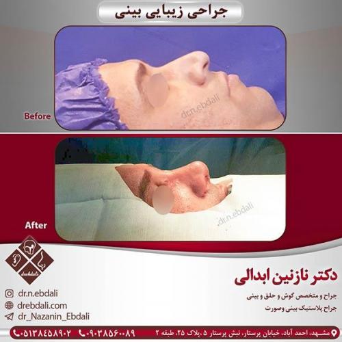 جراحی-بینی-مشهد-35