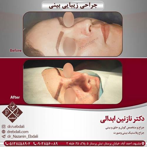 جراحی-بینی-مشهد-39