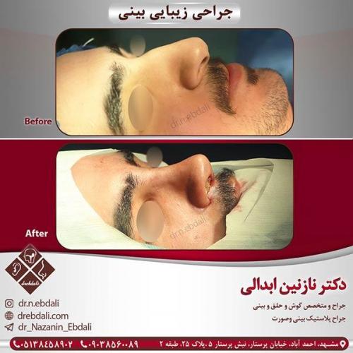 جراحی-بینی-مشهد-4