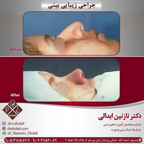 جراحی-بینی-مشهد-40