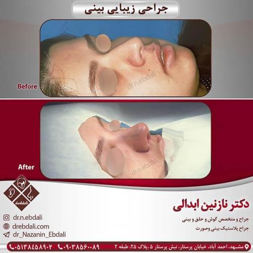 جراحی-بینی-مشهد-41