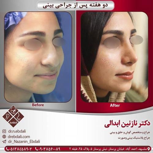 جراحی-بینی-مشهد-44