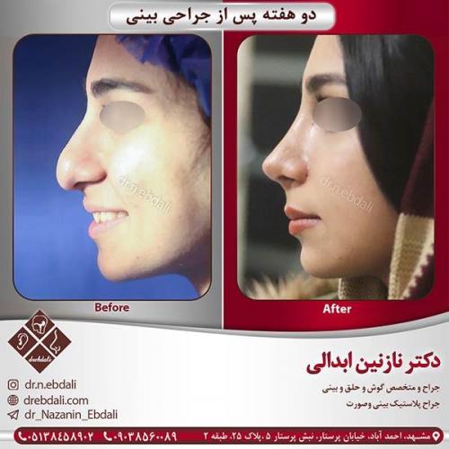 جراحی-بینی-مشهد-45