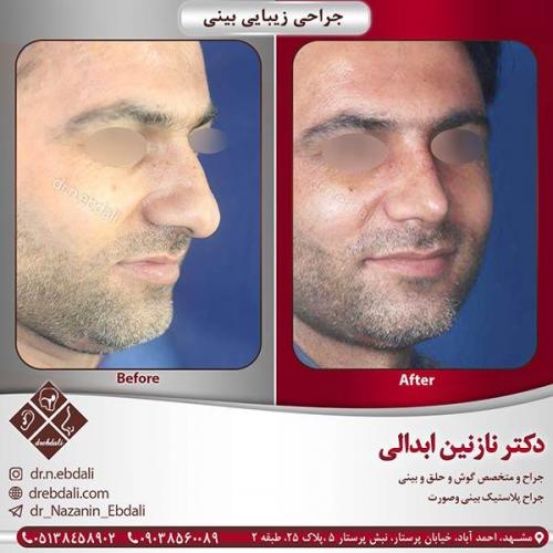 جراحی-بینی-مشهد-47