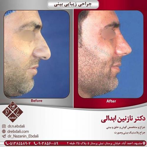 جراحی-بینی-مشهد-48