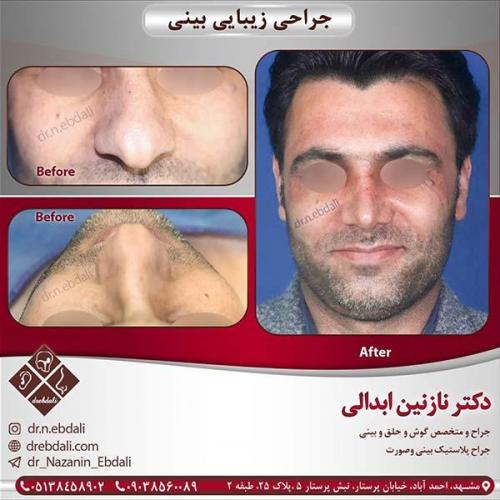 جراحی-بینی-مشهد-49