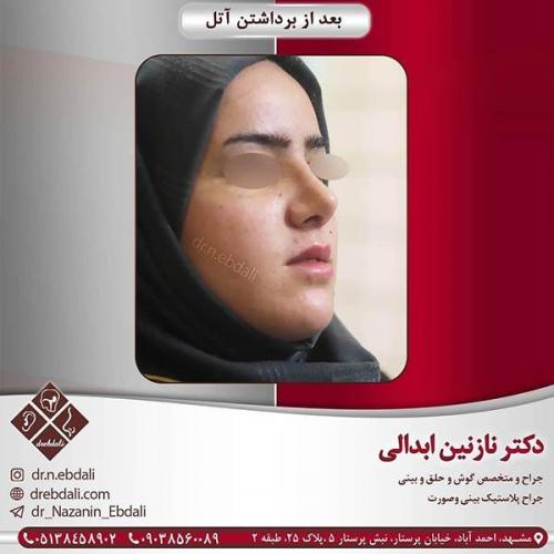 جراحی-بینی-مشهد-50