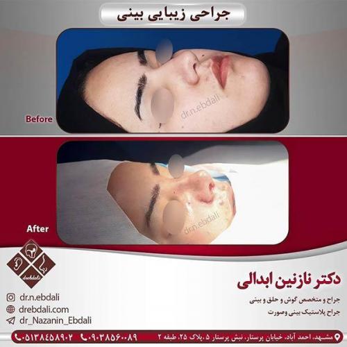 جراحی-بینی-مشهد-52
