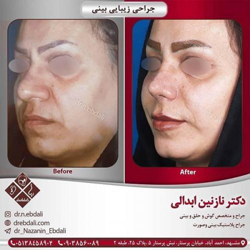 جراحی-بینی-مشهد-53