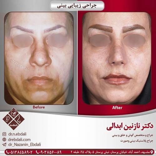 جراحی-بینی-مشهد-54