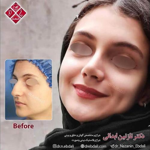 جراحی-بینی-مشهد-57