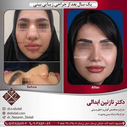 جراحی-بینی-مشهد-58