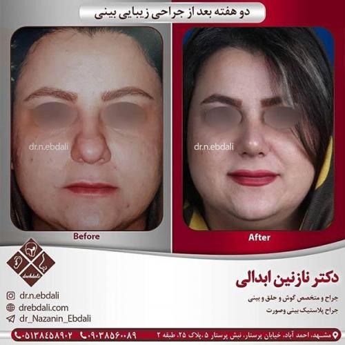 جراحی-بینی-مشهد-59