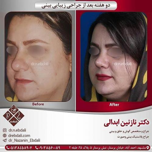 جراحی-بینی-مشهد-60
