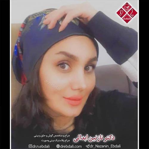 جراحی-بینی-مشهد-61
