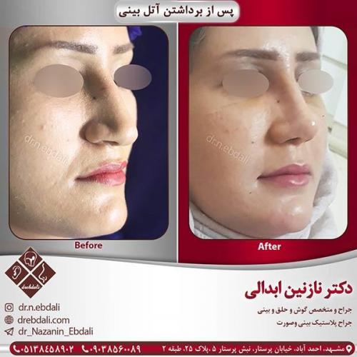جراحی-بینی-مشهد-62