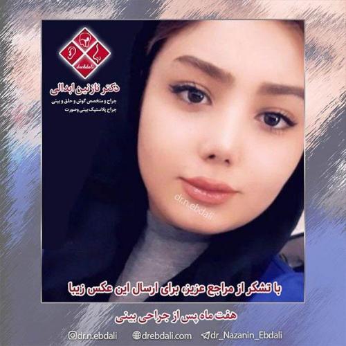 جراحی-بینی-مشهد-63