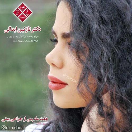 جراحی-بینی-مشهد-64