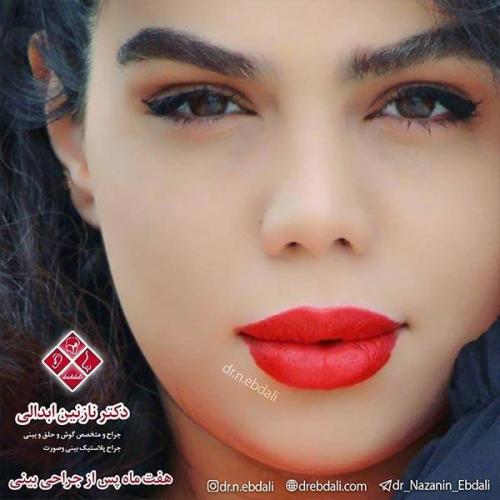 جراحی-بینی-مشهد-65