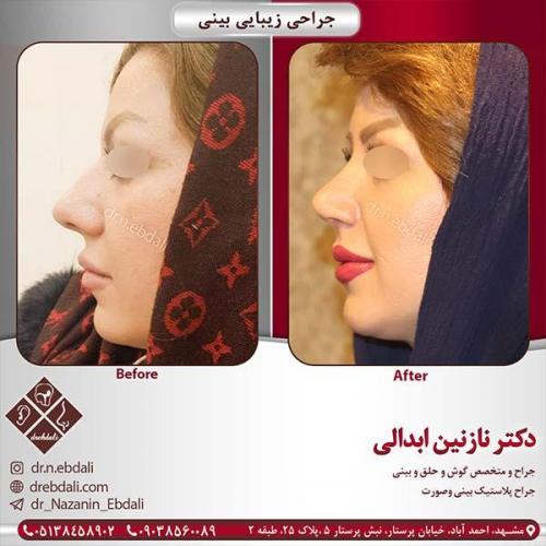 جراحی-بینی-مشهد-66