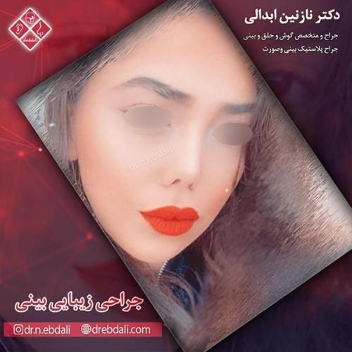 جراحی-بینی-مشهد-68