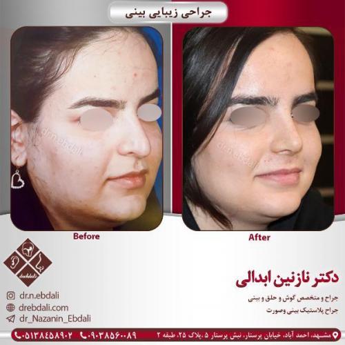 جراحی-بینی-مشهد-74
