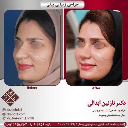 جراحی-بینی-مشهد-80