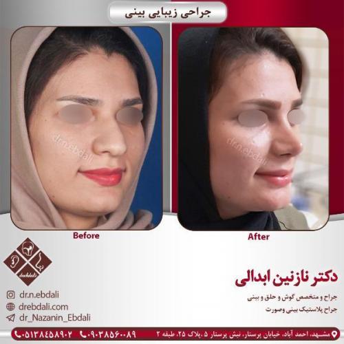 جراحی-بینی-مشهد-81