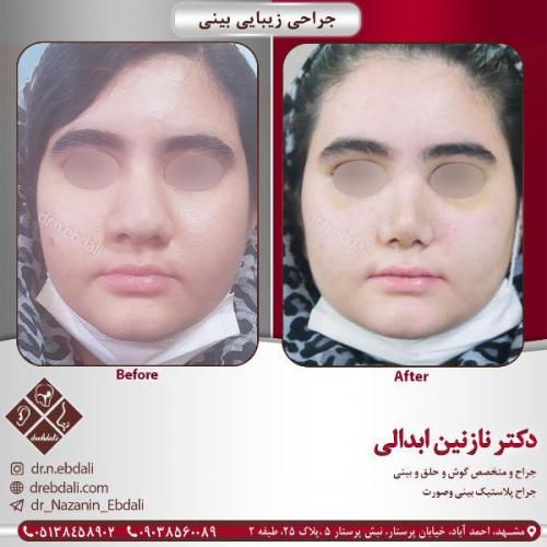 جراحی-بینی-مشهد-82