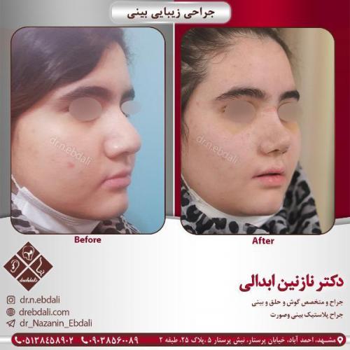 جراحی-بینی-مشهد-83