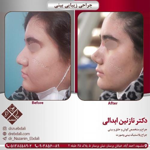 جراحی-بینی-مشهد-84