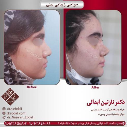 جراحی-بینی-مشهد-85