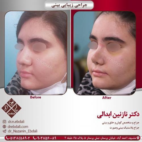 جراحی-بینی-مشهد-86