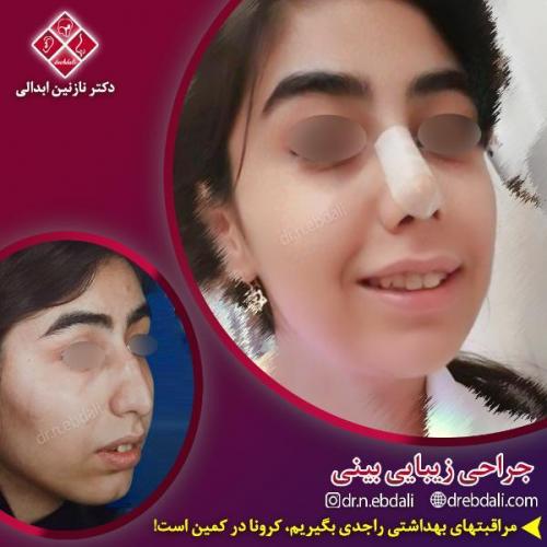 جراحی-بینی-مشهد-87