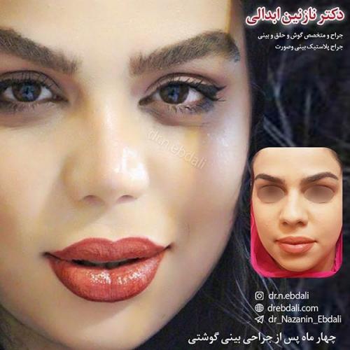 جراحی-بینی-مشهد-9