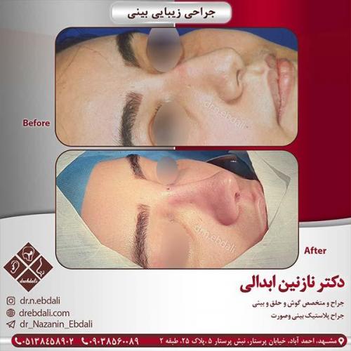 جراحی-بینی-مشهد-90